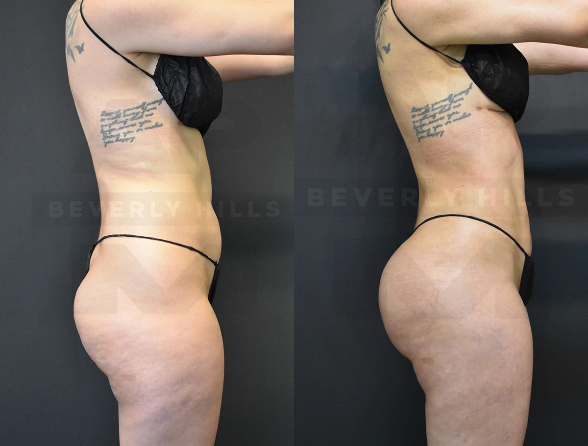 Real Patient Results of Dr. Andre P. Marshall providing Plastic Surgery services to his Beverly Hills & Los Angeles patients.