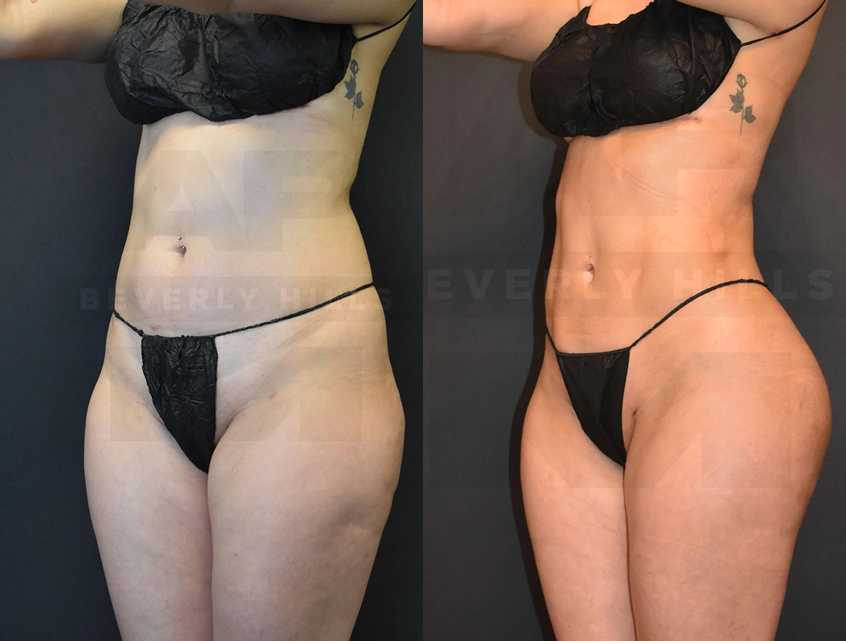 Real Patient Results of Dr. Andre P. Marshall providing Plastic Surgery services to his Beverly Hills & Los Angeles patients.