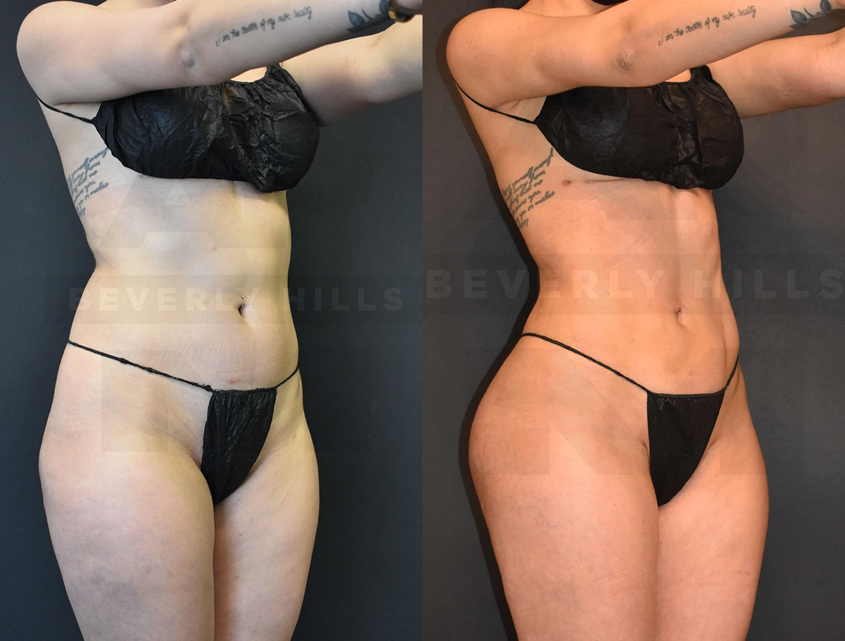 Real Patient Results of Dr. Andre P. Marshall providing Plastic Surgery services to his Beverly Hills & Los Angeles patients.