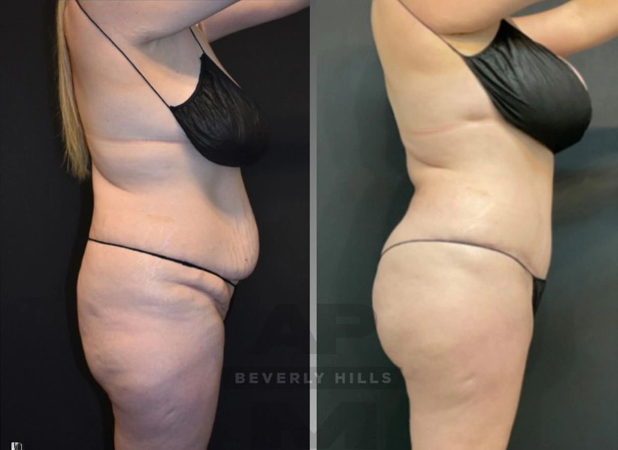 Real Patient Results by Dr. Marshall or Andrew P. Marshall Plastic Surgery serving Beverly Hills & Los Angeles, CA