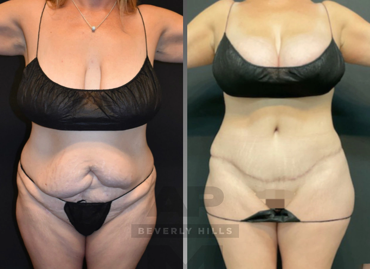 Real Patient Results by Dr. Marshall or Andrew P. Marshall Plastic Surgery serving Beverly Hills & Los Angeles, CA