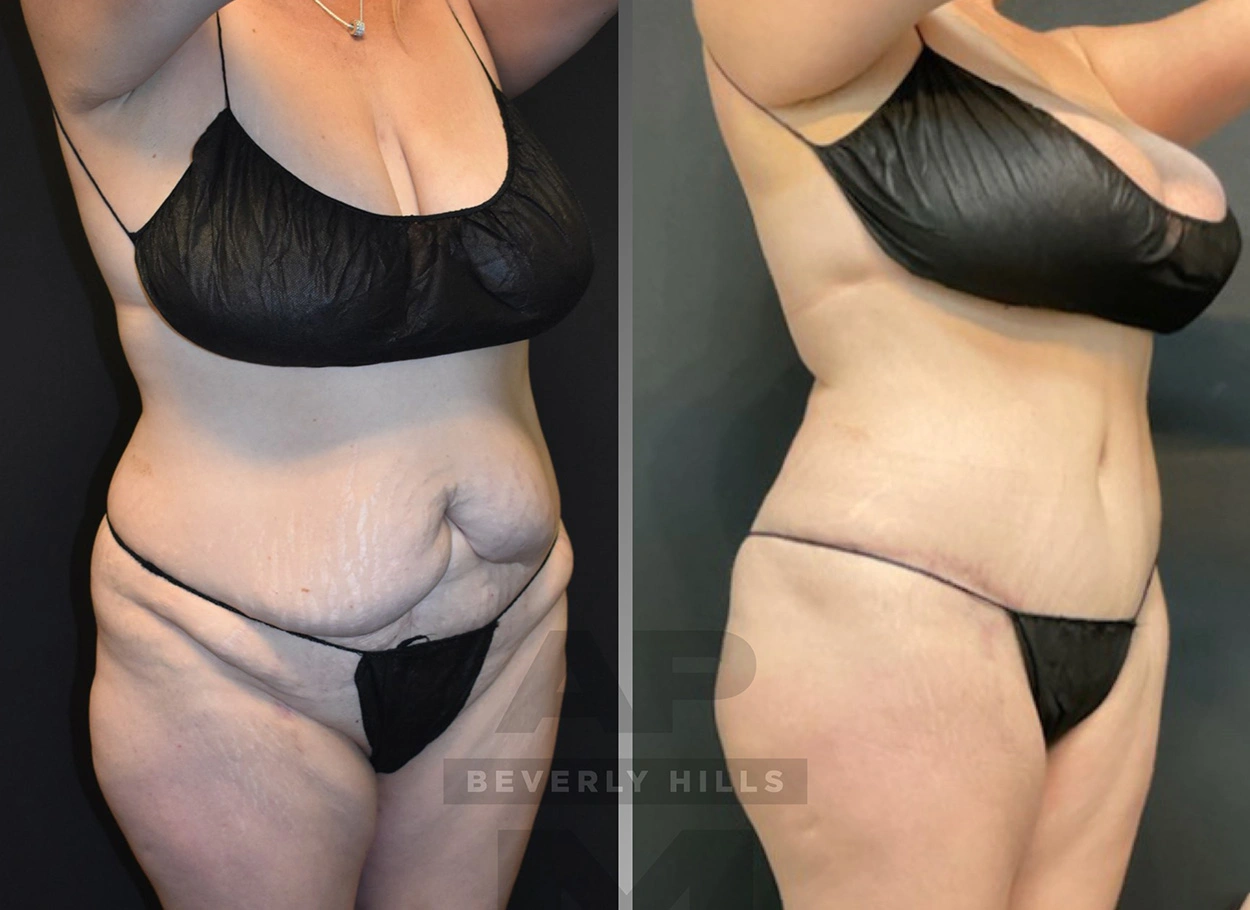 Real Patient Results by Dr. Marshall or Andrew P. Marshall Plastic Surgery serving Beverly Hills & Los Angeles, CA