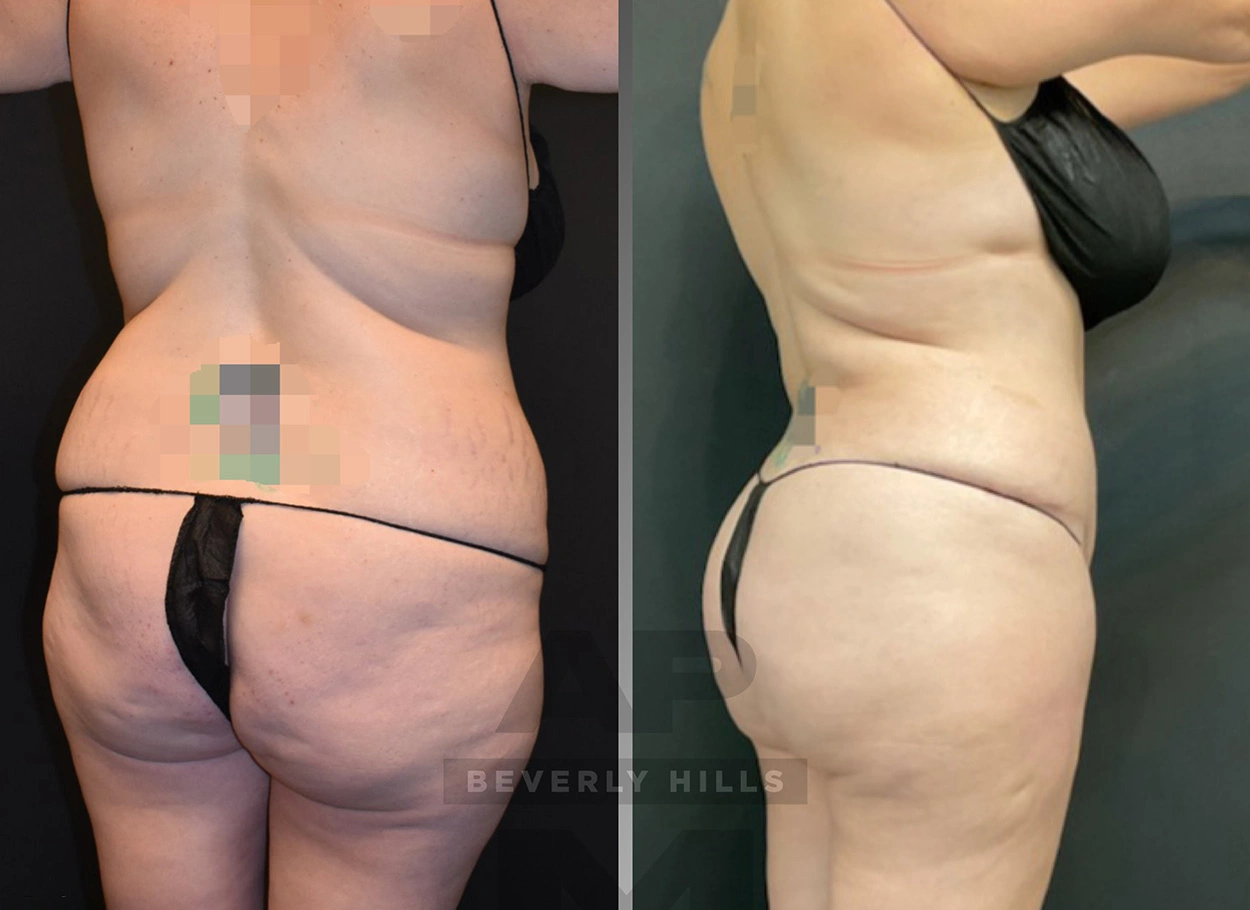 Real Patient Results by Dr. Marshall or Andrew P. Marshall Plastic Surgery serving Beverly Hills & Los Angeles, CA