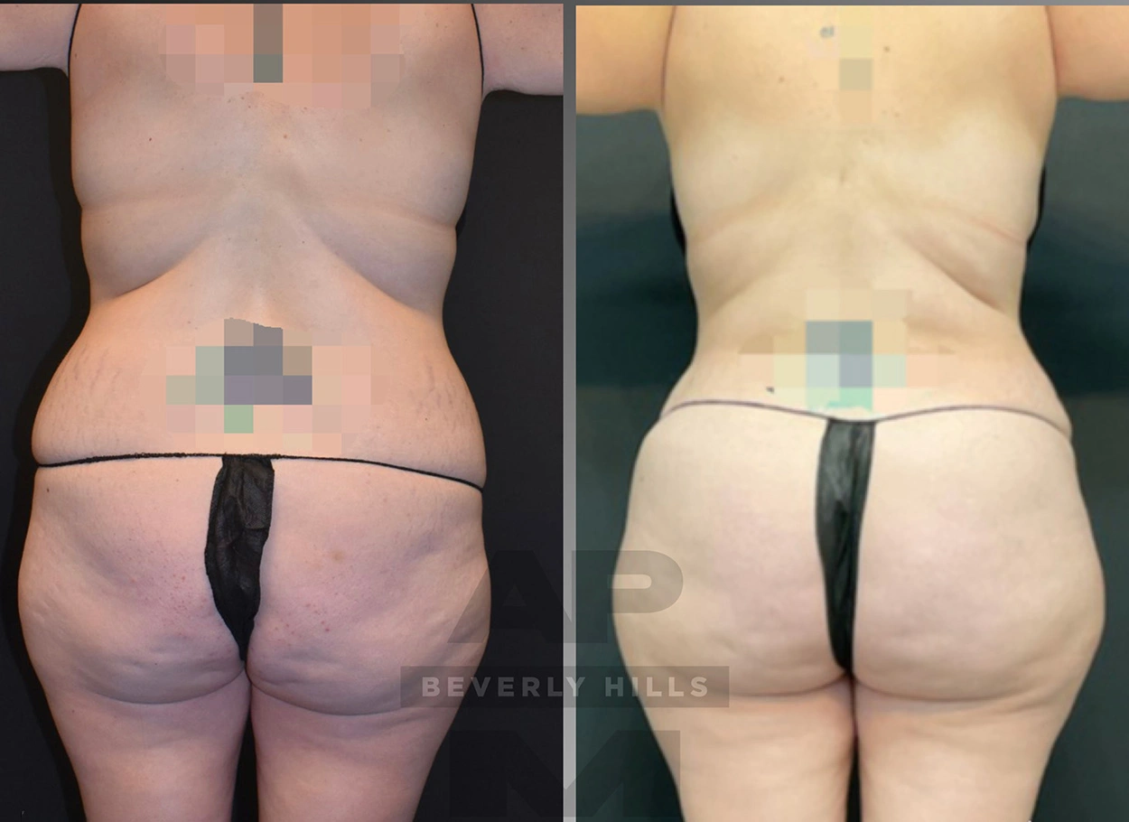 Real Patient Results by Dr. Marshall or Andrew P. Marshall Plastic Surgery serving Beverly Hills & Los Angeles, CA