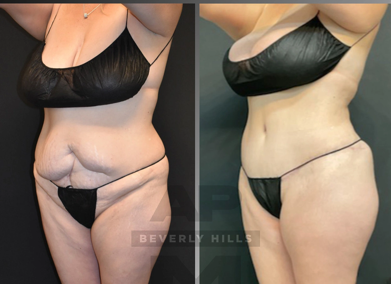 Real Patient Results by Dr. Marshall or Andrew P. Marshall Plastic Surgery serving Beverly Hills & Los Angeles, CA