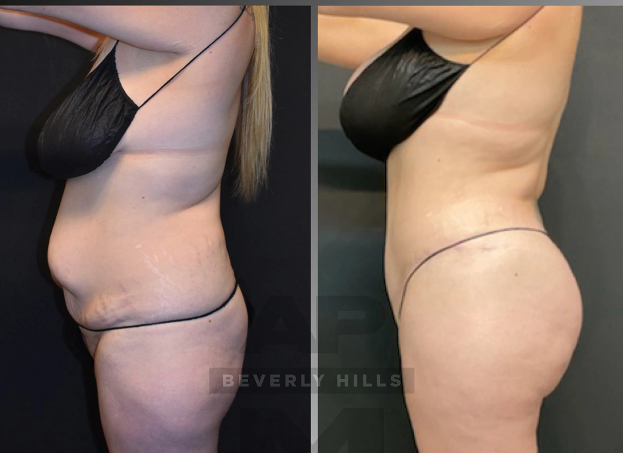 Real Patient Results by Dr. Marshall or Andrew P. Marshall Plastic Surgery serving Beverly Hills & Los Angeles, CA