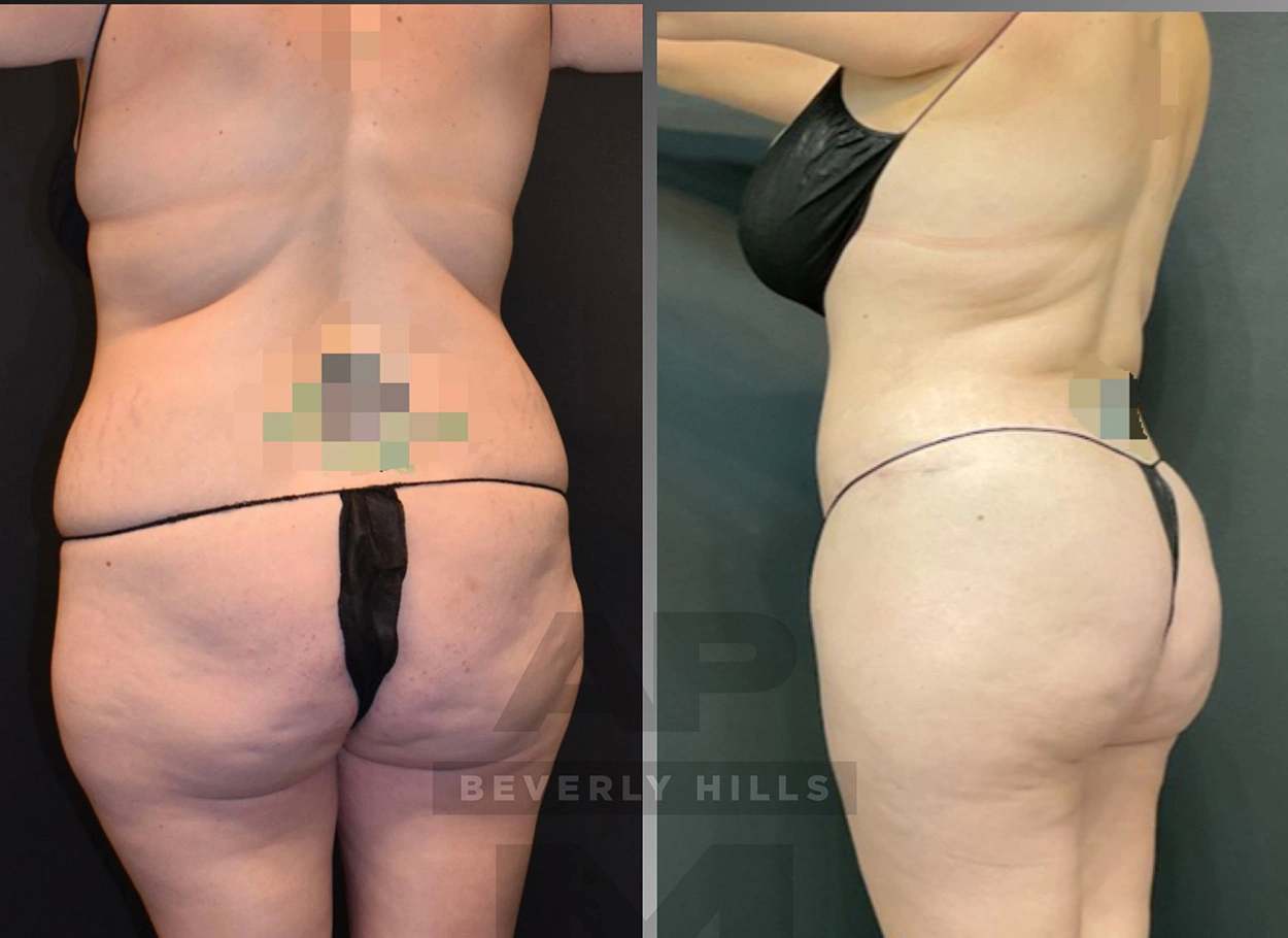 Real Patient Results by Dr. Marshall or Andrew P. Marshall Plastic Surgery serving Beverly Hills & Los Angeles, CA