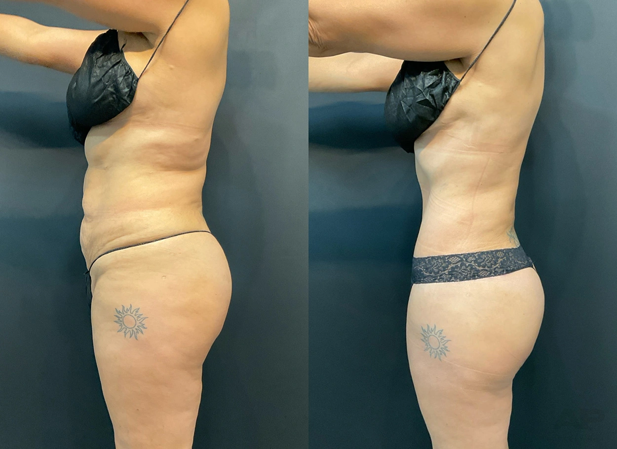 Real Patient Results by Dr. Marshall or Andrew P. Marshall Plastic Surgery serving Beverly Hills & Los Angeles, CA