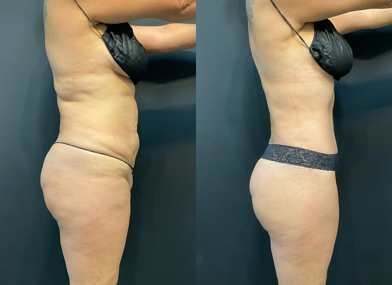 Real Patient Results by Dr. Marshall or Andrew P. Marshall Plastic Surgery serving Beverly Hills & Los Angeles, CA