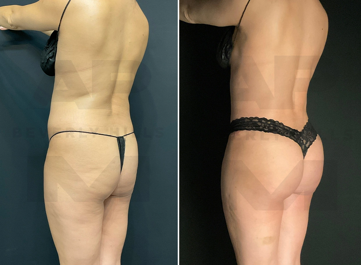 Real Patient Results by Dr. Marshall or Andrew P. Marshall Plastic Surgery serving Beverly Hills & Los Angeles, CA