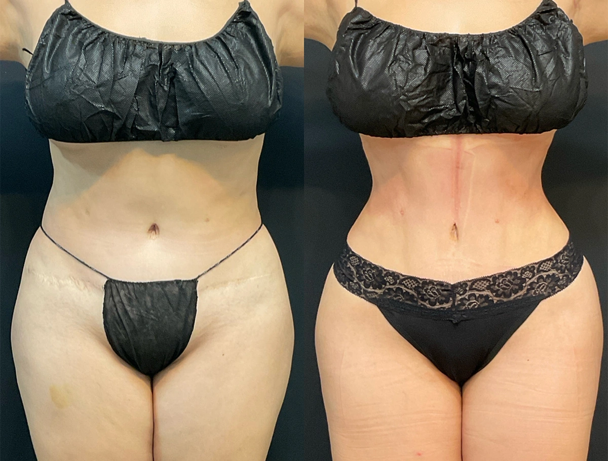 Real Patient Results by Dr. Marshall or Andrew P. Marshall Plastic Surgery serving Beverly Hills & Los Angeles, CA