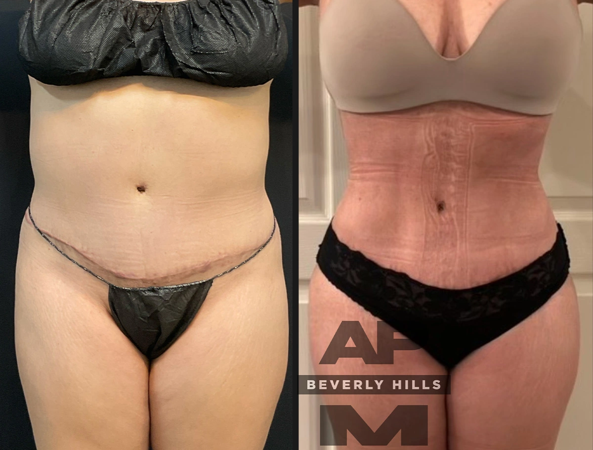 Real Patient Results by Dr. Marshall or Andrew P. Marshall Plastic Surgery serving Beverly Hills & Los Angeles, CA