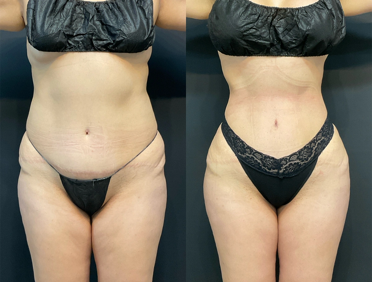 Real Patient Results by Dr. Marshall or Andrew P. Marshall Plastic Surgery serving Beverly Hills & Los Angeles, CA