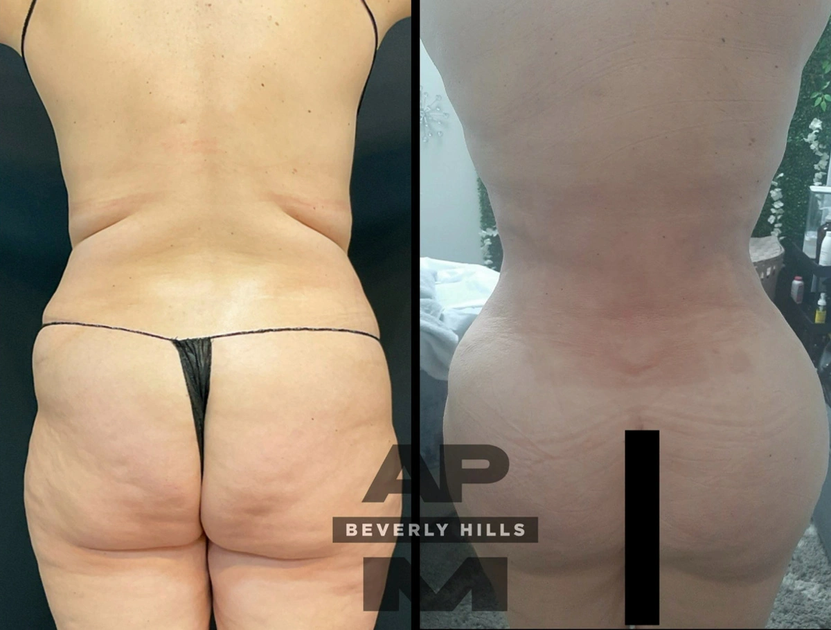 Real Patient Results by Dr. Marshall or Andrew P. Marshall Plastic Surgery serving Beverly Hills & Los Angeles, CA