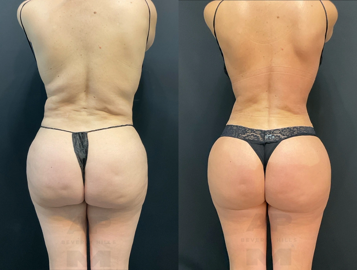 Real Patient Results by Dr. Marshall or Andrew P. Marshall Plastic Surgery serving Beverly Hills & Los Angeles, CA