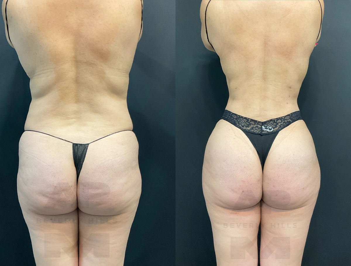 Real Patient Results by Dr. Marshall or Andrew P. Marshall Plastic Surgery serving Beverly Hills & Los Angeles, CA