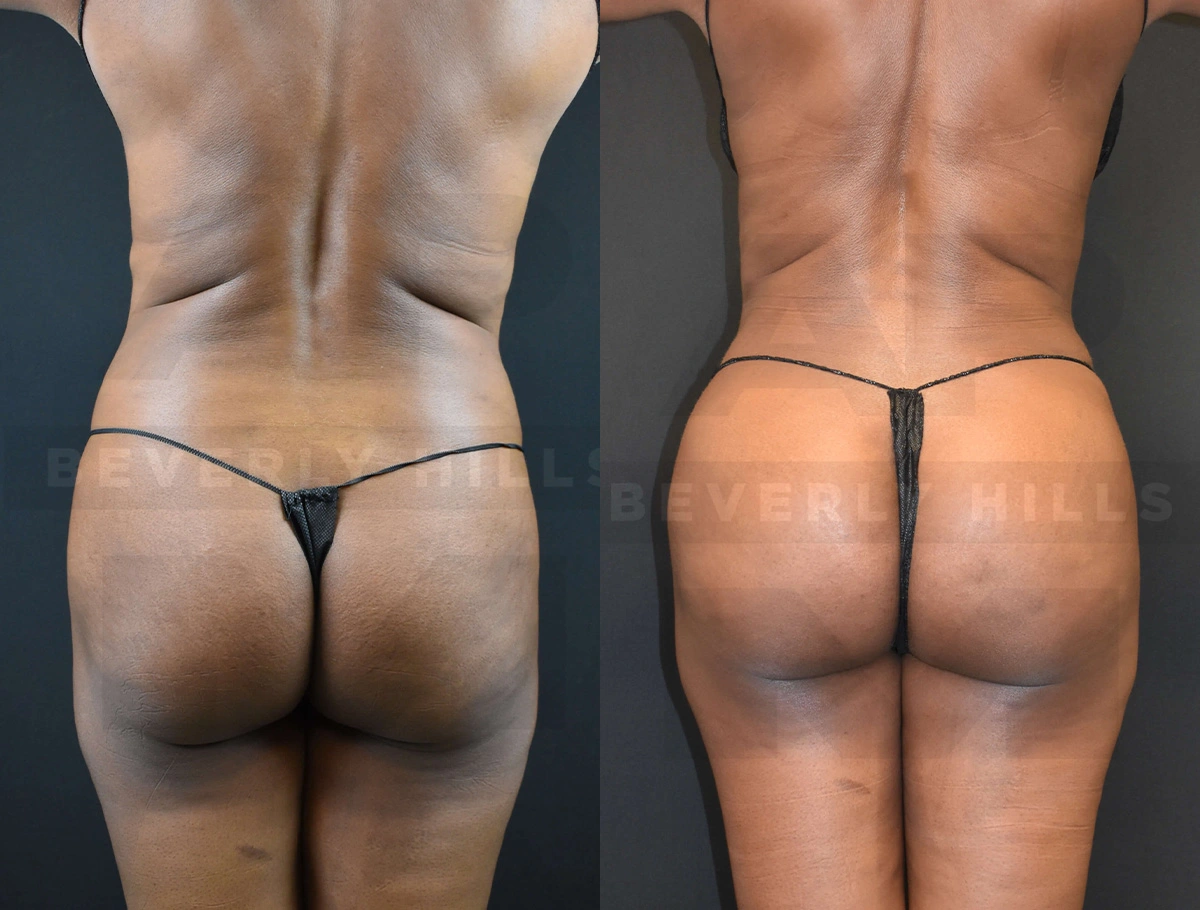 Real Patient Results of Dr. Andre P. Marshall providing Plastic Surgery services to his Beverly Hills & Los Angeles patients.