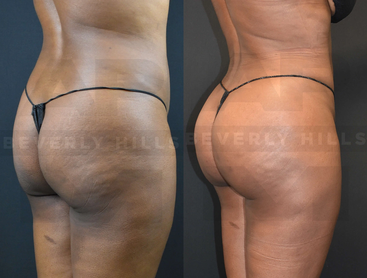 Real Patient Results of Dr. Andre P. Marshall providing Plastic Surgery services to his Beverly Hills & Los Angeles patients.