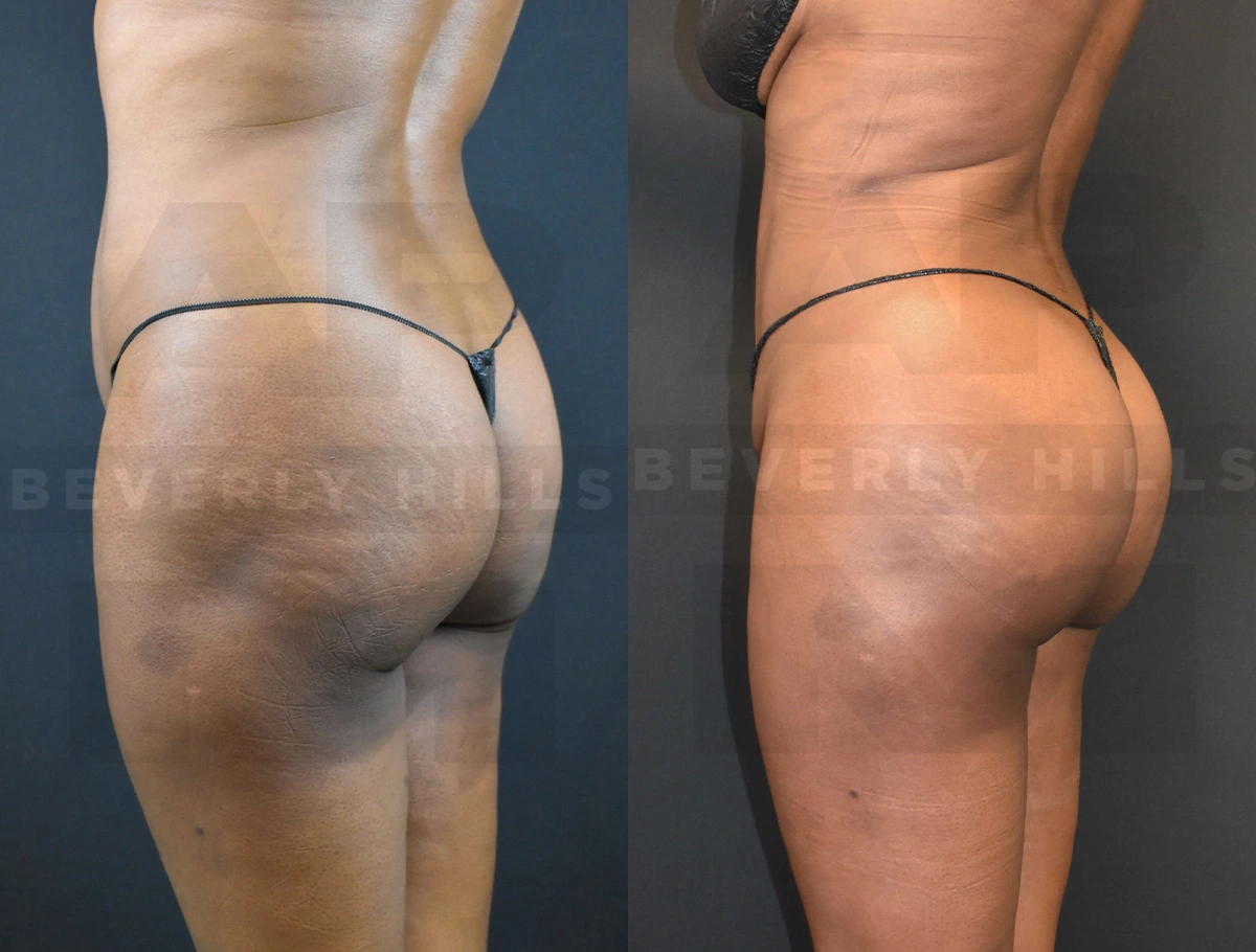 Real Patient Results of Dr. Andre P. Marshall providing Plastic Surgery services to his Beverly Hills & Los Angeles patients.