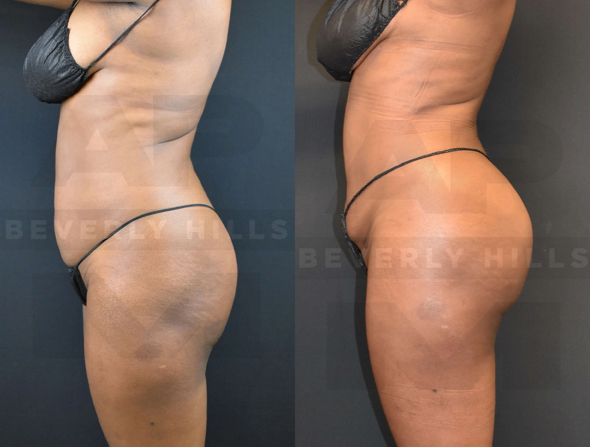 Real Patient Results of Dr. Andre P. Marshall providing Plastic Surgery services to his Beverly Hills & Los Angeles patients.