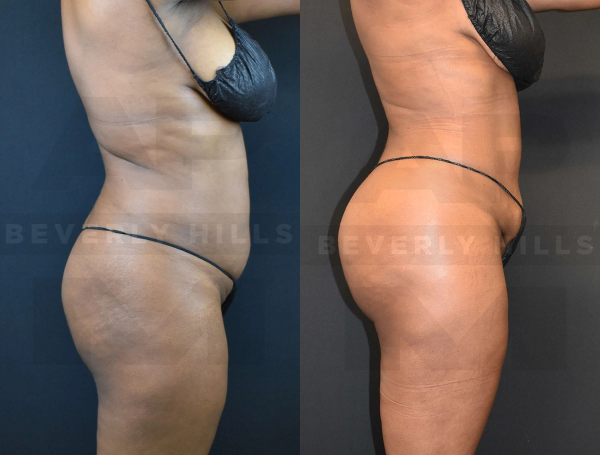 Real Patient Results of Dr. Andre P. Marshall providing Plastic Surgery services to his Beverly Hills & Los Angeles patients.