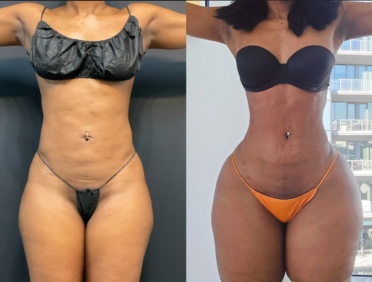 Real Patient Results by Dr. Marshall or Andrew P. Marshall Plastic Surgery serving Beverly Hills & Los Angeles, CA