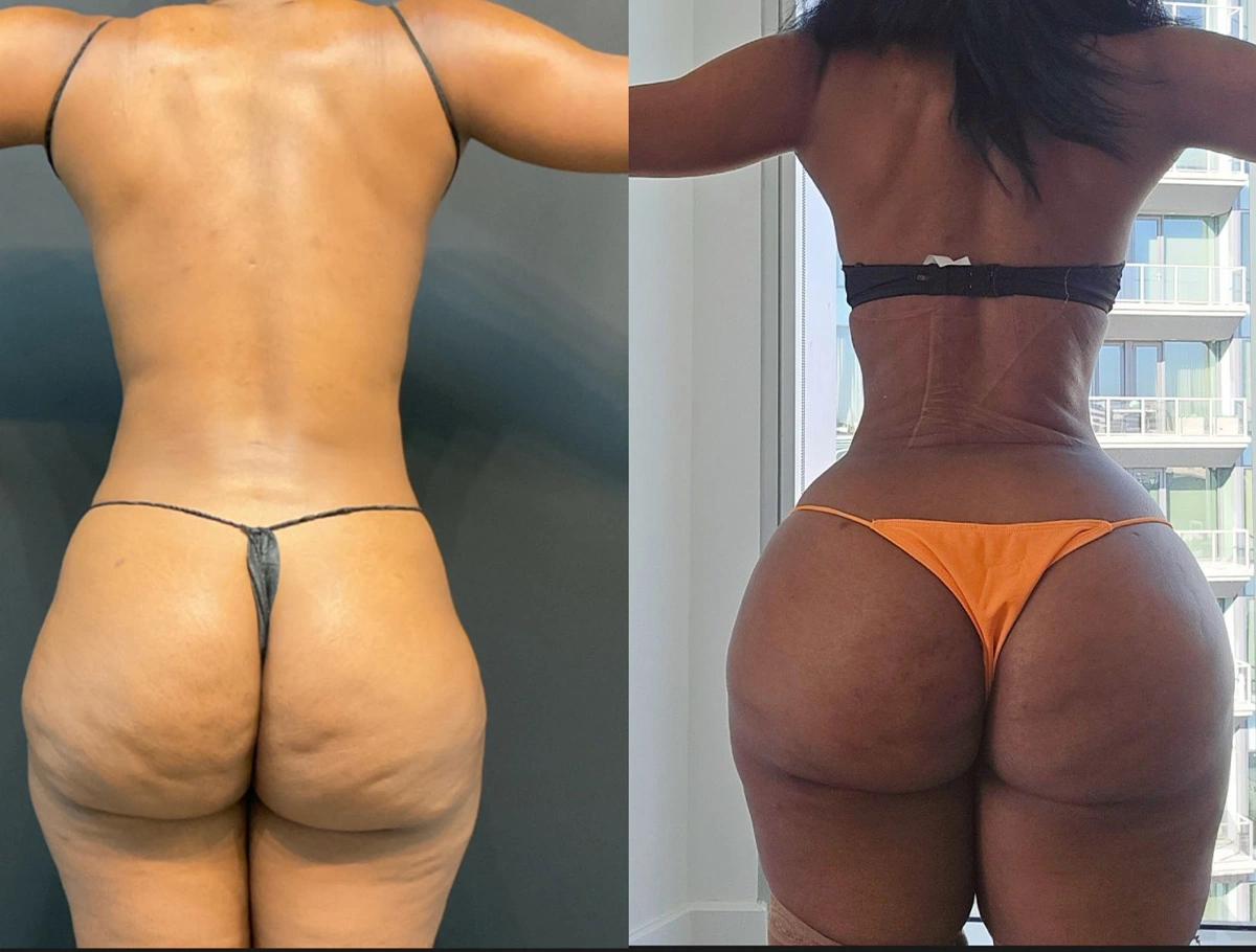 Real Patient Results by Dr. Marshall or Andrew P. Marshall Plastic Surgery serving Beverly Hills & Los Angeles, CA