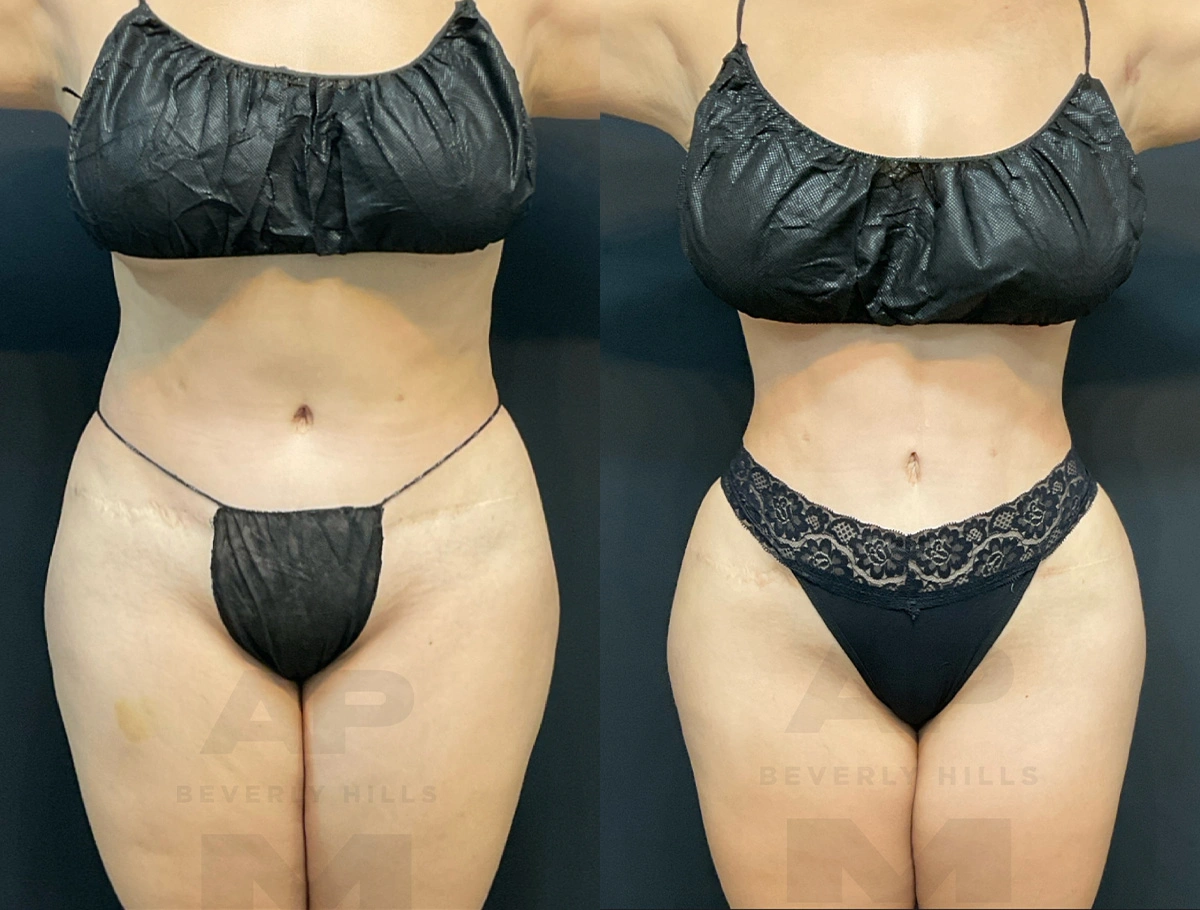 Real Patient Results by Dr. Marshall or Andrew P. Marshall Plastic Surgery serving Beverly Hills & Los Angeles, CA