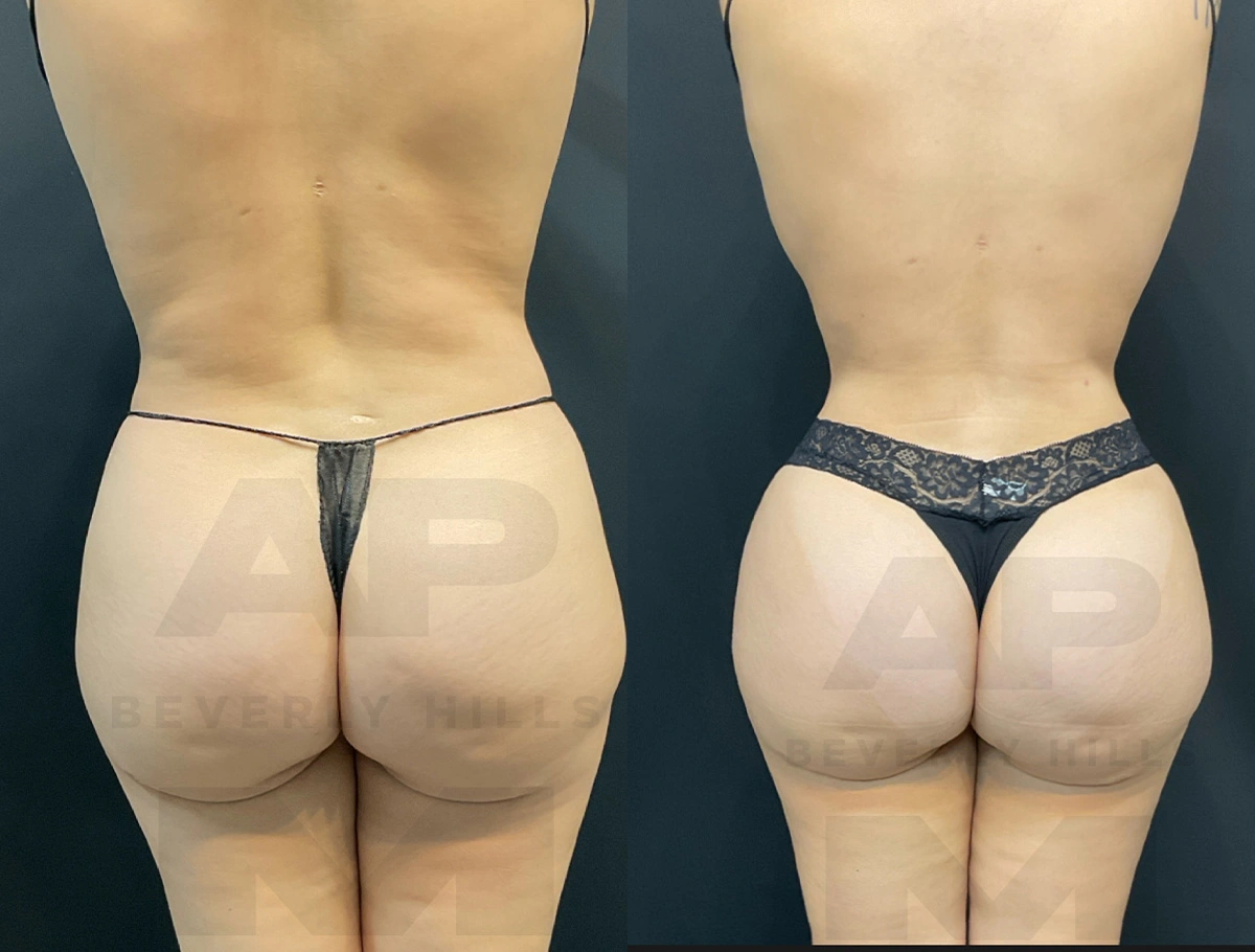 Real Patient Results by Dr. Marshall or Andrew P. Marshall Plastic Surgery serving Beverly Hills & Los Angeles, CA