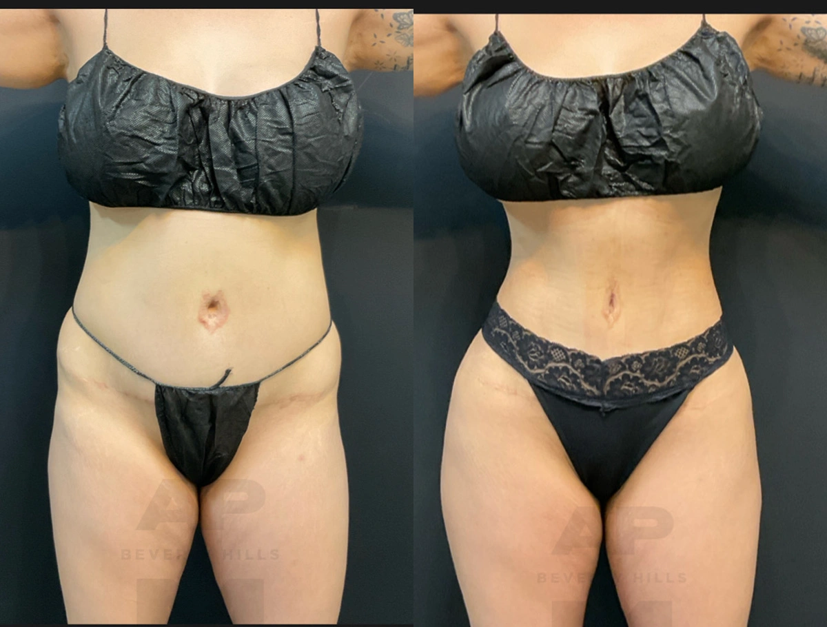 Real Patient Results by Dr. Marshall or Andrew P. Marshall Plastic Surgery serving Beverly Hills & Los Angeles, CA