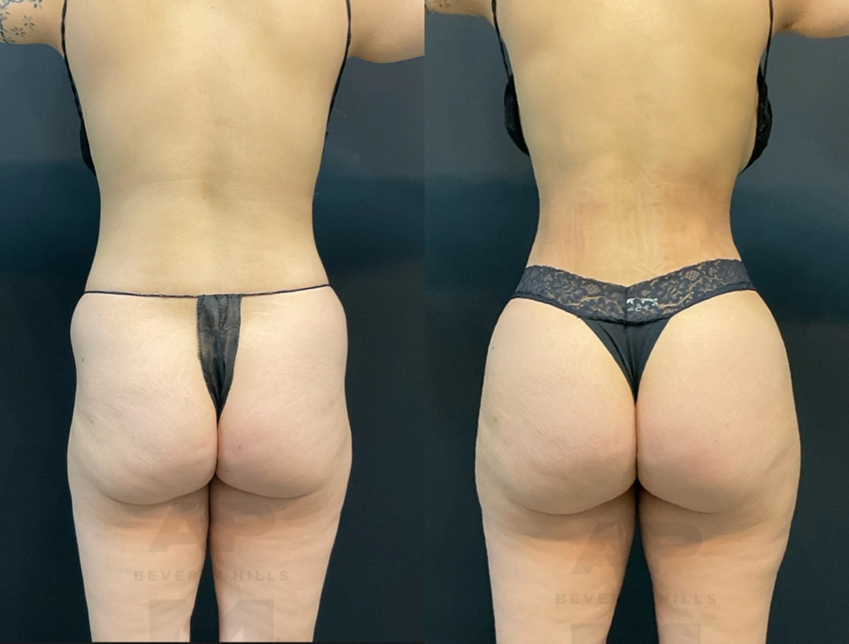 Real Patient Results by Dr. Marshall or Andrew P. Marshall Plastic Surgery serving Beverly Hills & Los Angeles, CA