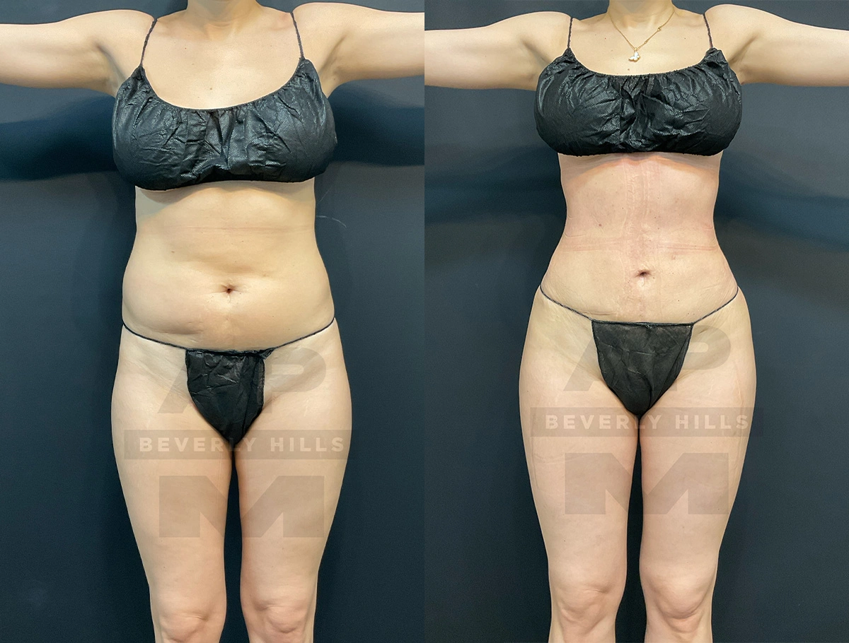 Real Patient Results by Dr. Marshall or Andrew P. Marshall Plastic Surgery serving Beverly Hills & Los Angeles, CA