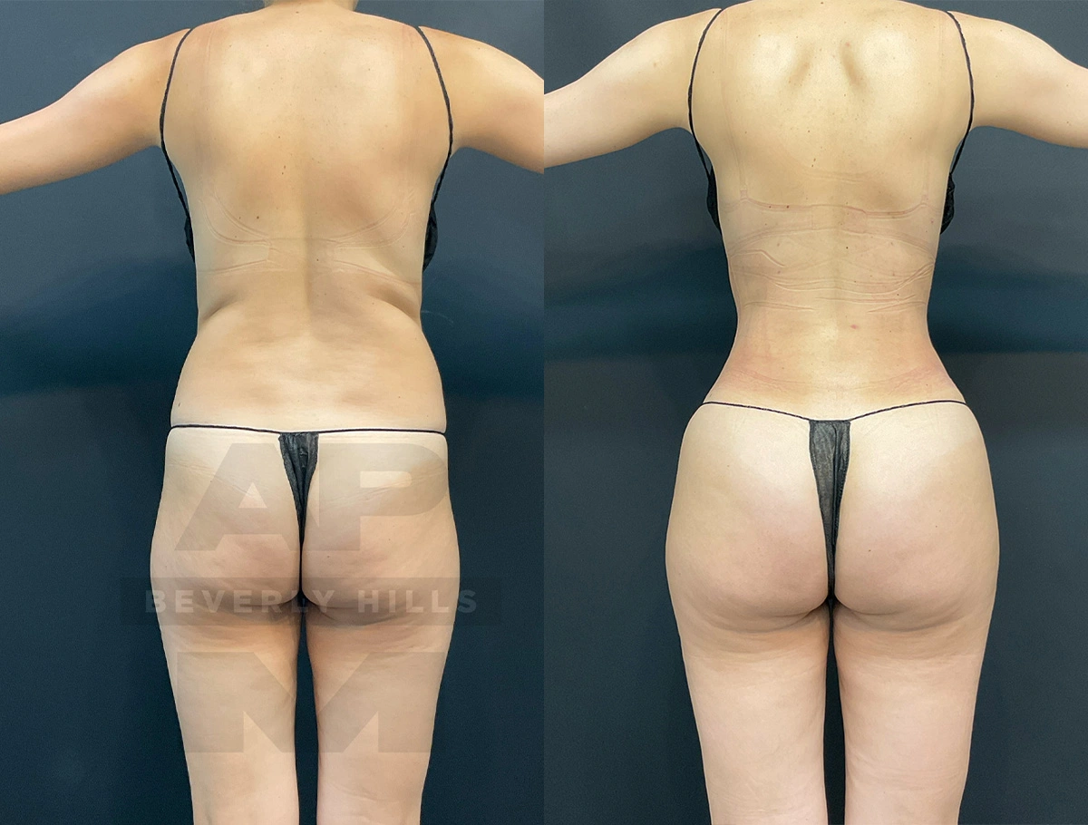 Real Patient Results by Dr. Marshall or Andrew P. Marshall Plastic Surgery serving Beverly Hills & Los Angeles, CA