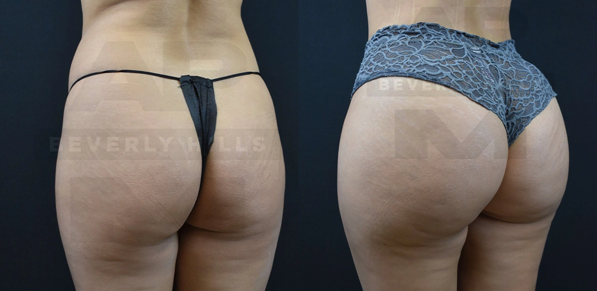 Real Patient Results of Dr. Andre P. Marshall providing Plastic Surgery services to his Beverly Hills & Los Angeles patients.