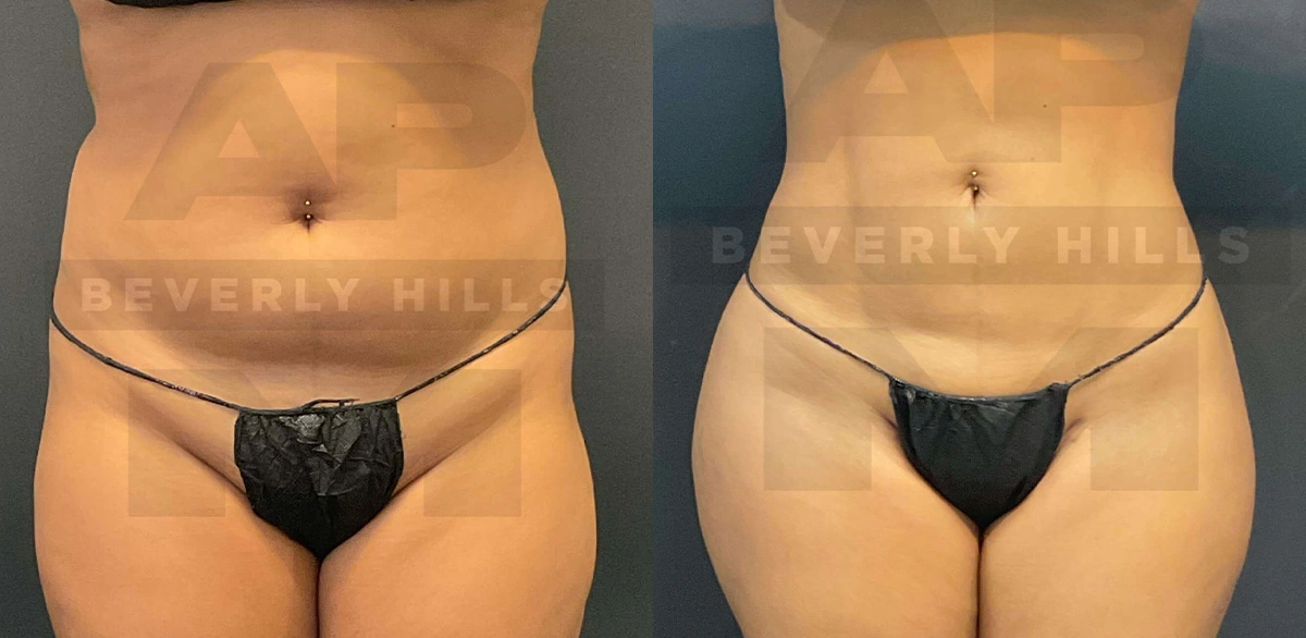 Real Patient Results of Dr. Andre P. Marshall providing Plastic Surgery services to his Beverly Hills & Los Angeles patients.