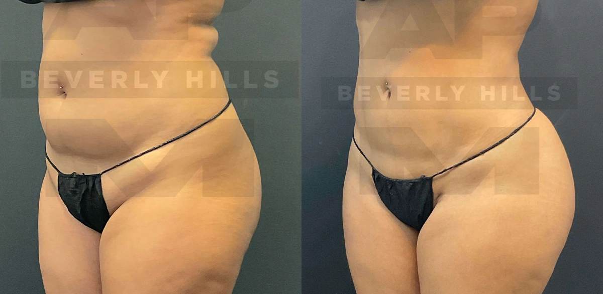 Real Patient Results of Dr. Andre P. Marshall providing Plastic Surgery services to his Beverly Hills & Los Angeles patients.