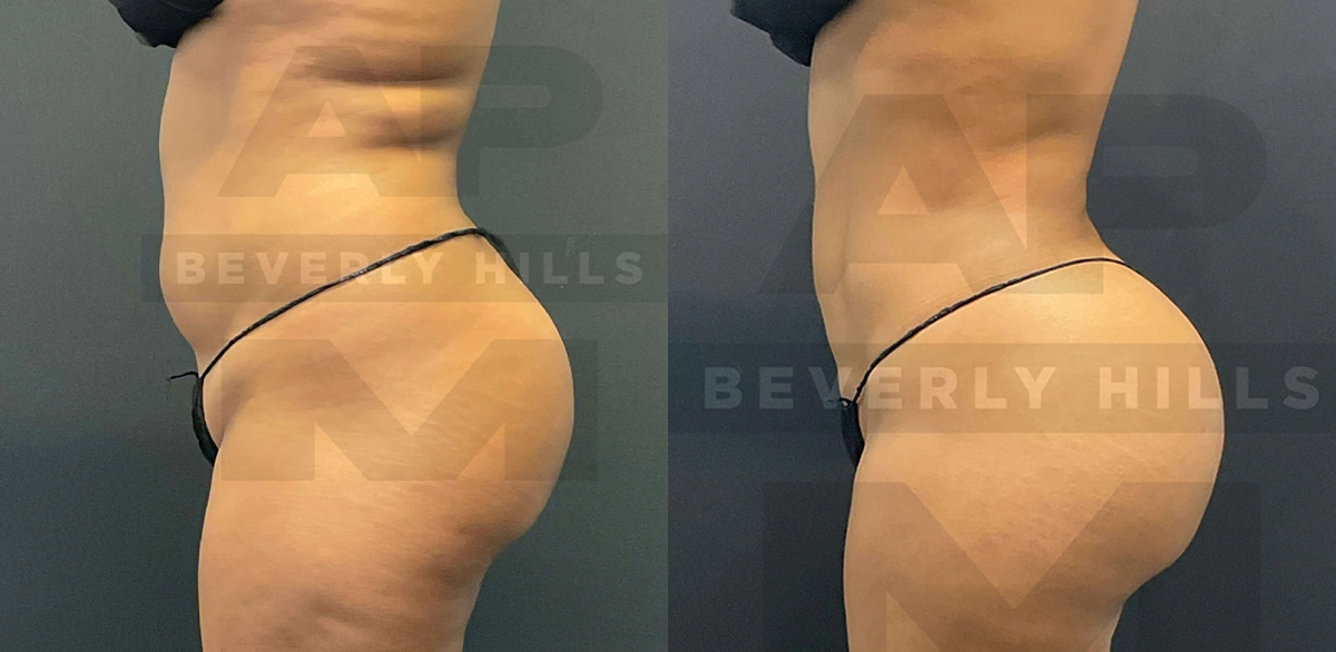 Real Patient Results of Dr. Andre P. Marshall providing Plastic Surgery services to his Beverly Hills & Los Angeles patients.