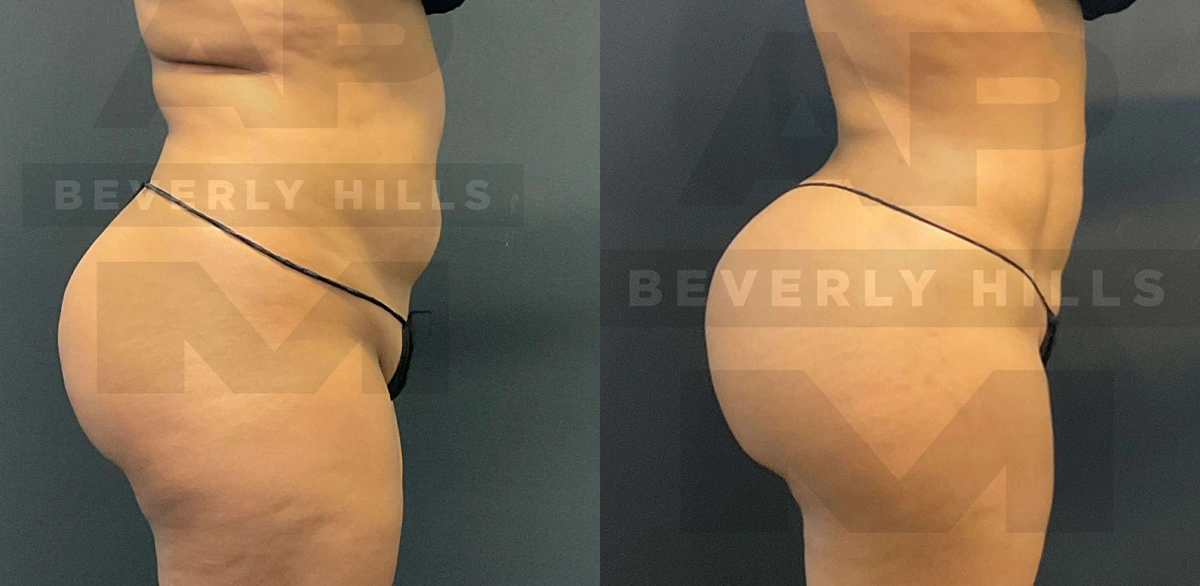 Real Patient Results of Dr. Andre P. Marshall providing Plastic Surgery services to his Beverly Hills & Los Angeles patients.