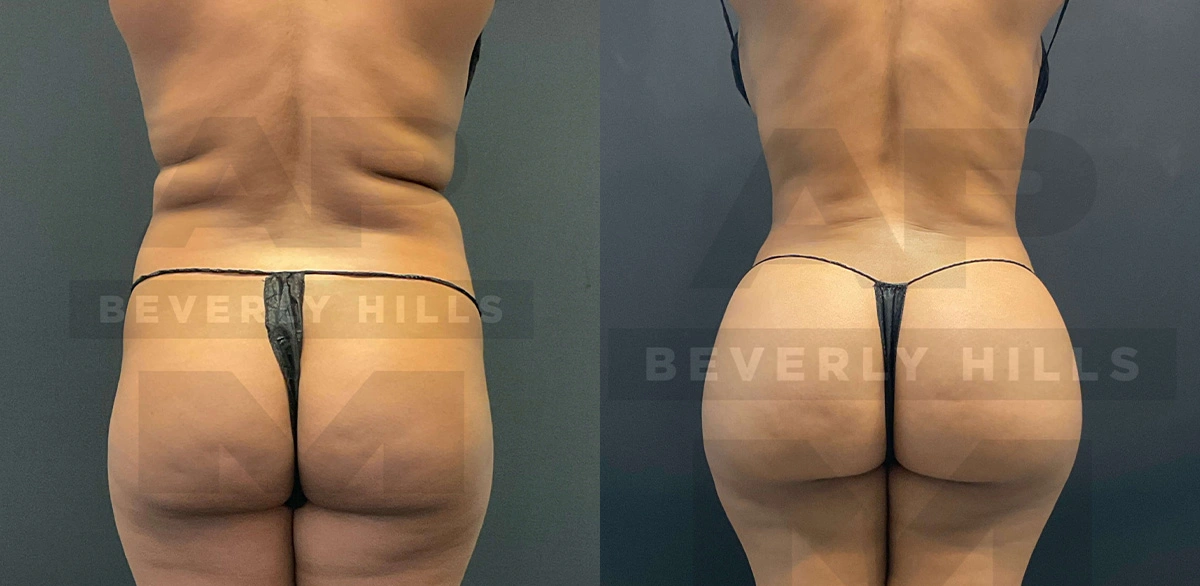 Real Patient Results of Dr. Andre P. Marshall providing Plastic Surgery services to his Beverly Hills & Los Angeles patients.