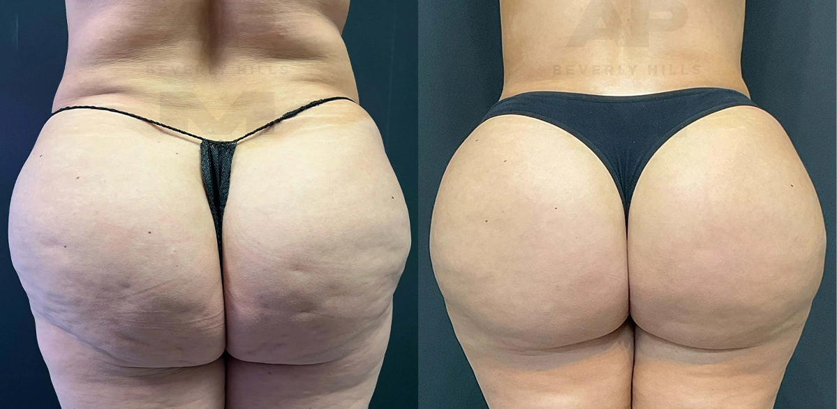 Real Patient Results of Dr. Andre P. Marshall providing Plastic Surgery services to his Beverly Hills & Los Angeles patients.