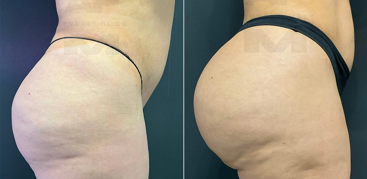 Real Patient Results of Dr. Andre P. Marshall providing Plastic Surgery services to his Beverly Hills & Los Angeles patients.