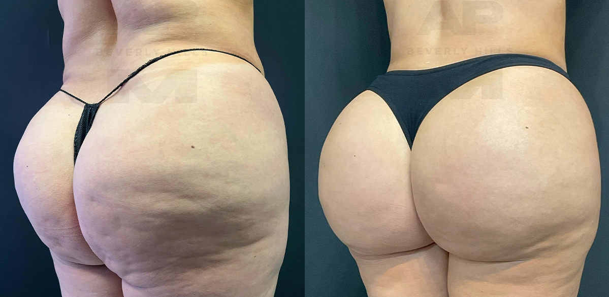 Real Patient Results of Dr. Andre P. Marshall providing Plastic Surgery services to his Beverly Hills & Los Angeles patients.