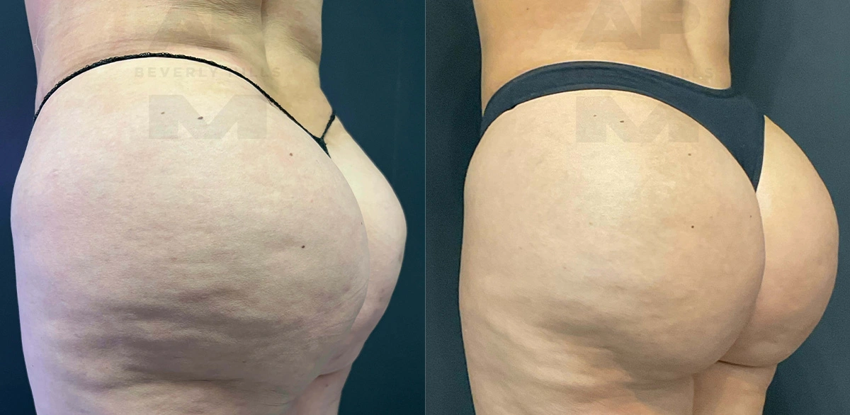 Real Patient Results of Dr. Andre P. Marshall providing Plastic Surgery services to his Beverly Hills & Los Angeles patients.