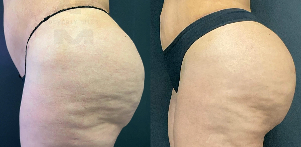 Real Patient Results of Dr. Andre P. Marshall providing Plastic Surgery services to his Beverly Hills & Los Angeles patients.