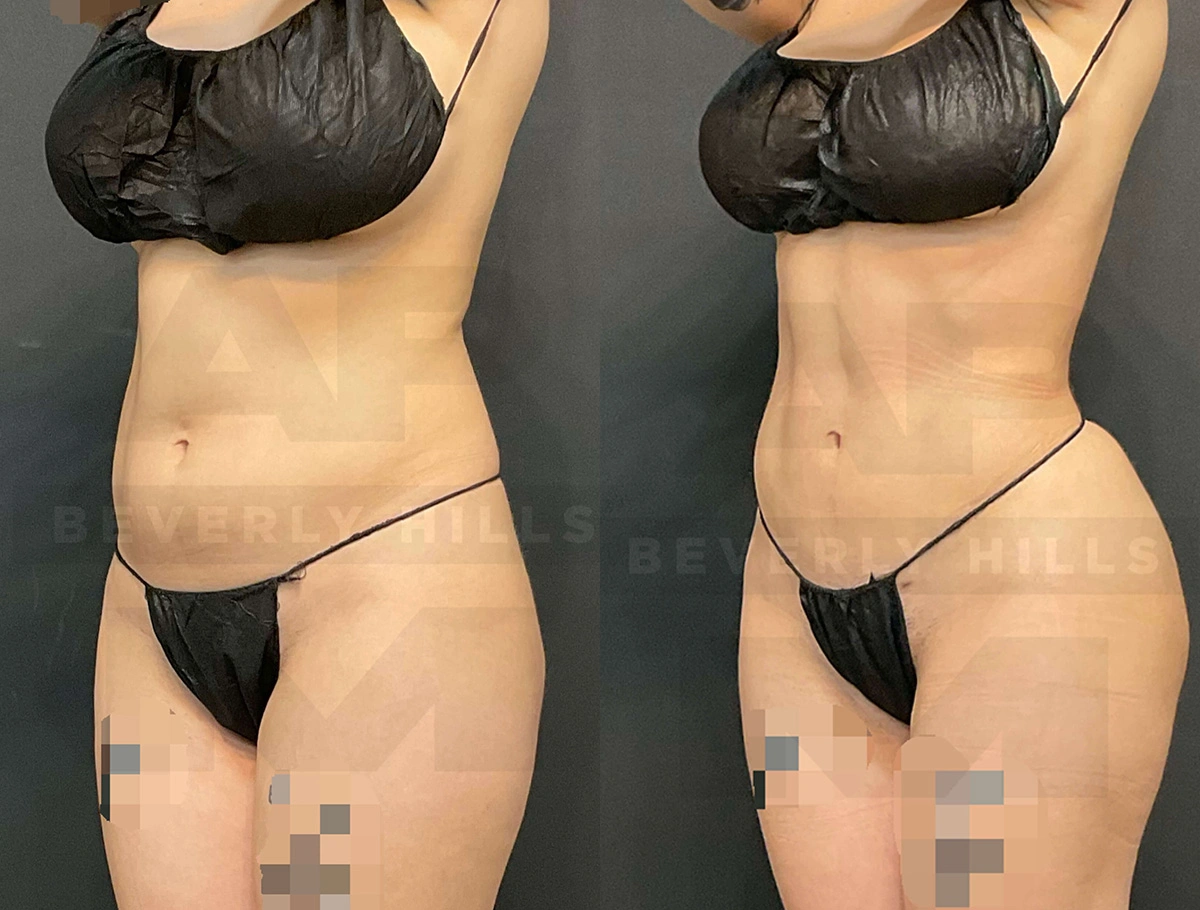 Real Patient Results of Dr. Andre P. Marshall providing Plastic Surgery services to his Beverly Hills & Los Angeles patients.