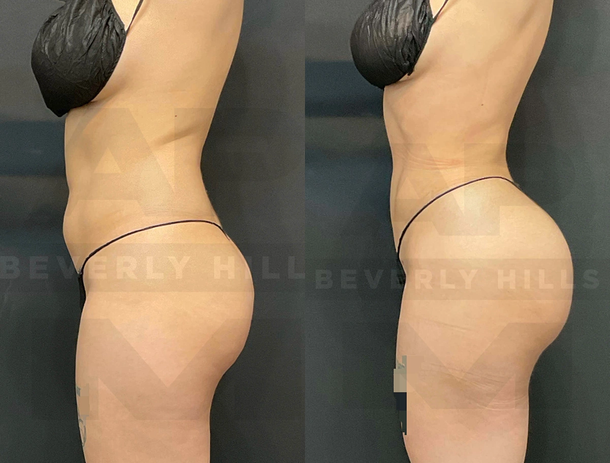 Real Patient Results of Dr. Andre P. Marshall providing Plastic Surgery services to his Beverly Hills & Los Angeles patients.