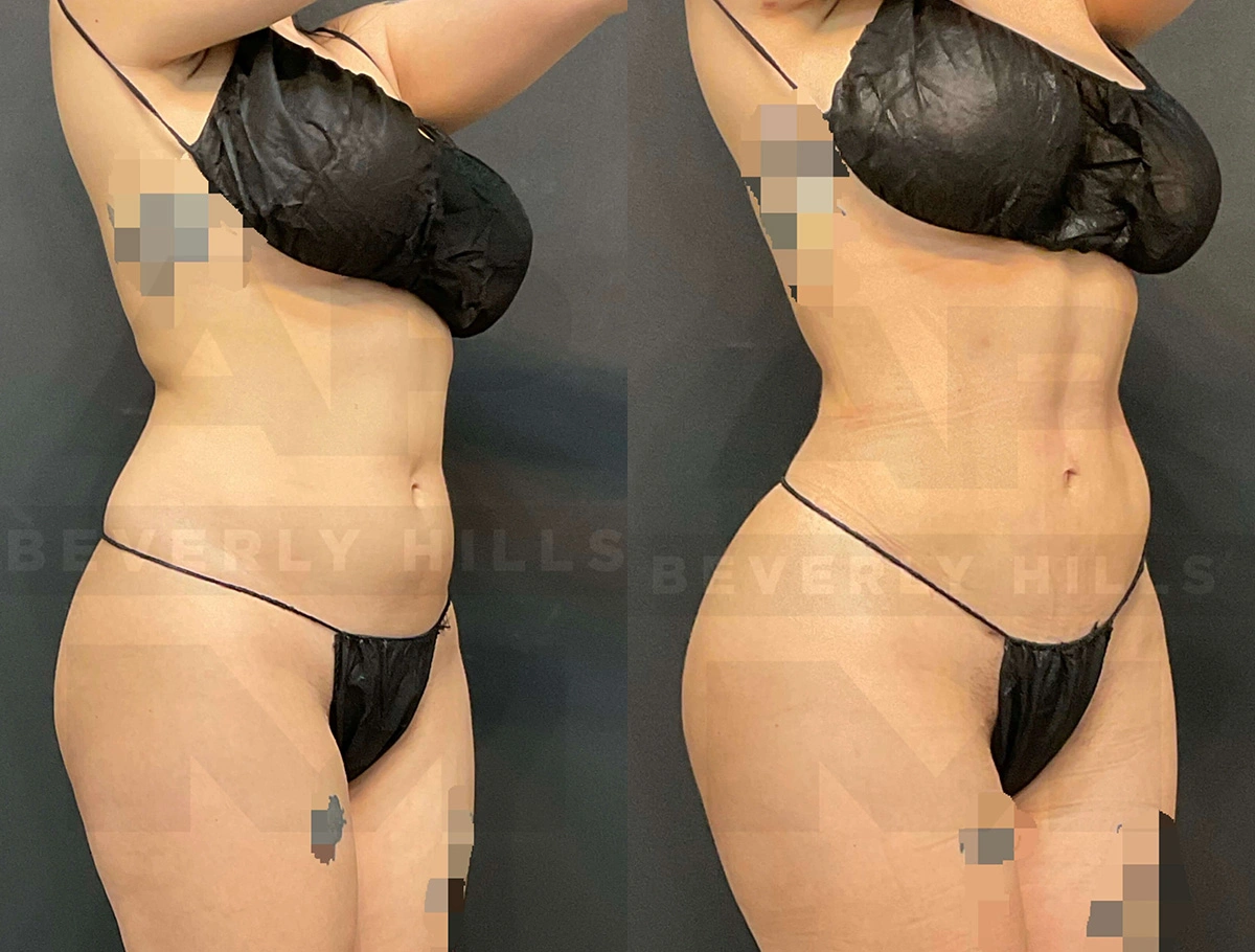 Real Patient Results of Dr. Andre P. Marshall providing Plastic Surgery services to his Beverly Hills & Los Angeles patients.