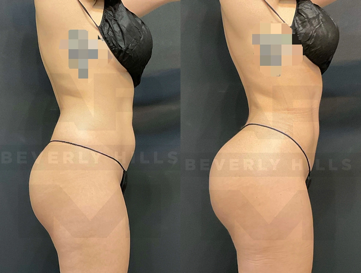 Real Patient Results of Dr. Andre P. Marshall providing Plastic Surgery services to his Beverly Hills & Los Angeles patients.