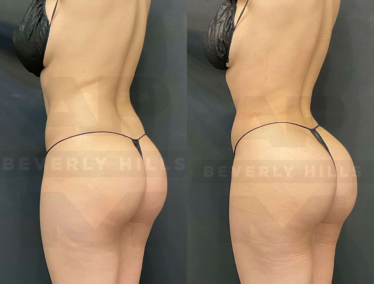 Real Patient Results of Dr. Andre P. Marshall providing Plastic Surgery services to his Beverly Hills & Los Angeles patients.