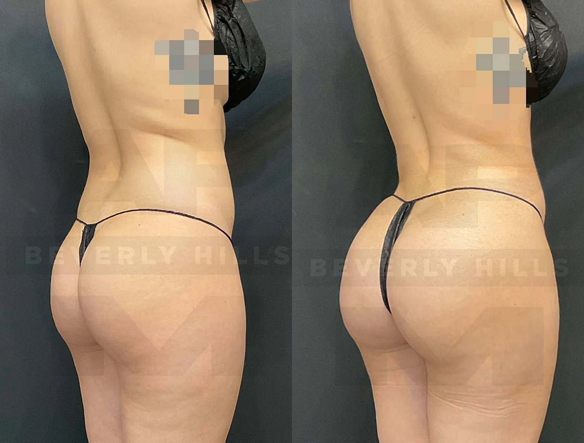 Real Patient Results of Dr. Andre P. Marshall providing Plastic Surgery services to his Beverly Hills & Los Angeles patients.